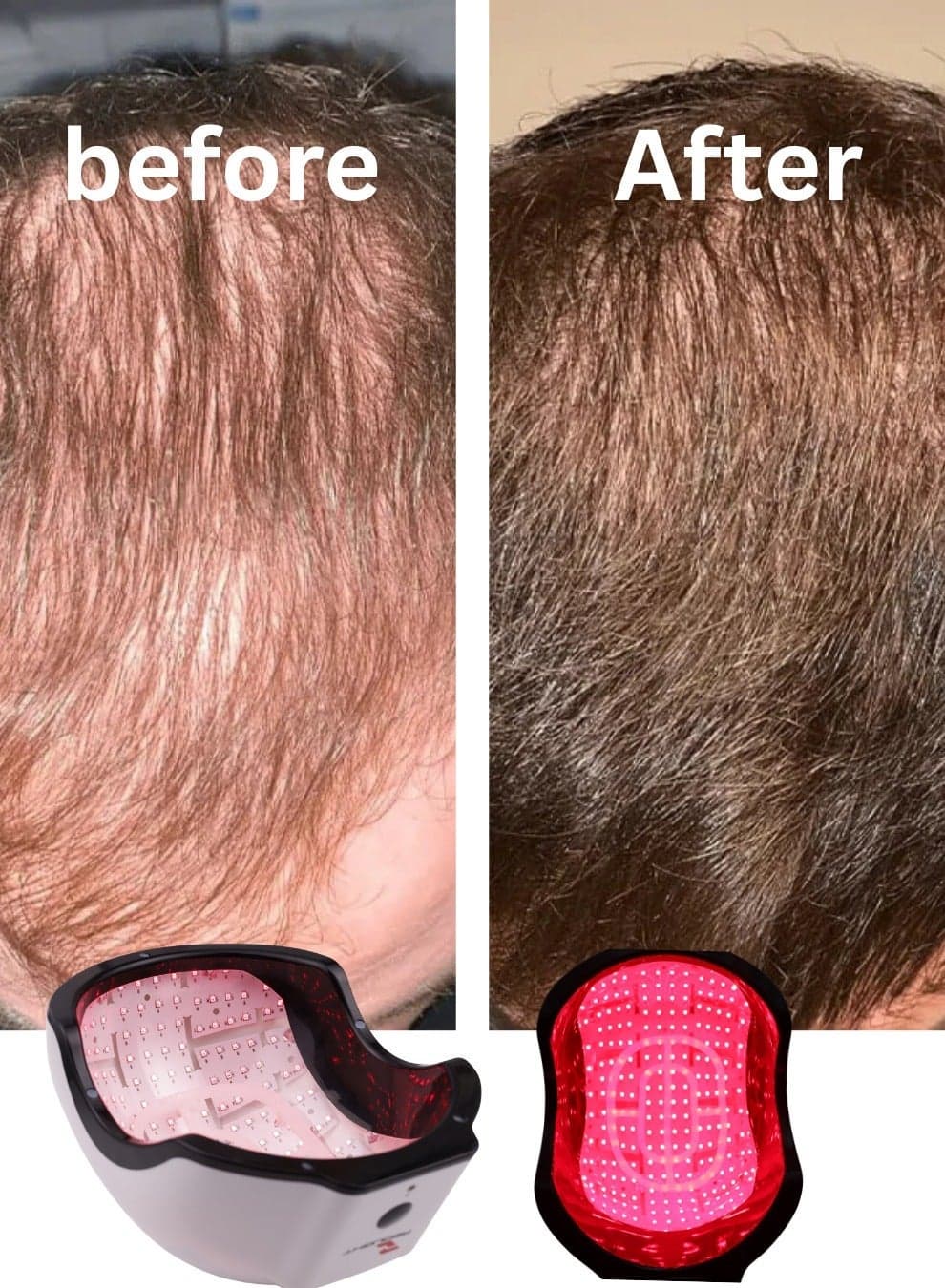 ATTRACTIVE GT Laser Hair Growth Helmet RL272 PRO for Men & Women | Laser Therapy Cap for Hair Regrowth | Anti Hair Loss & Thinning Treatment Device | Rechargeable LLLT Helmet